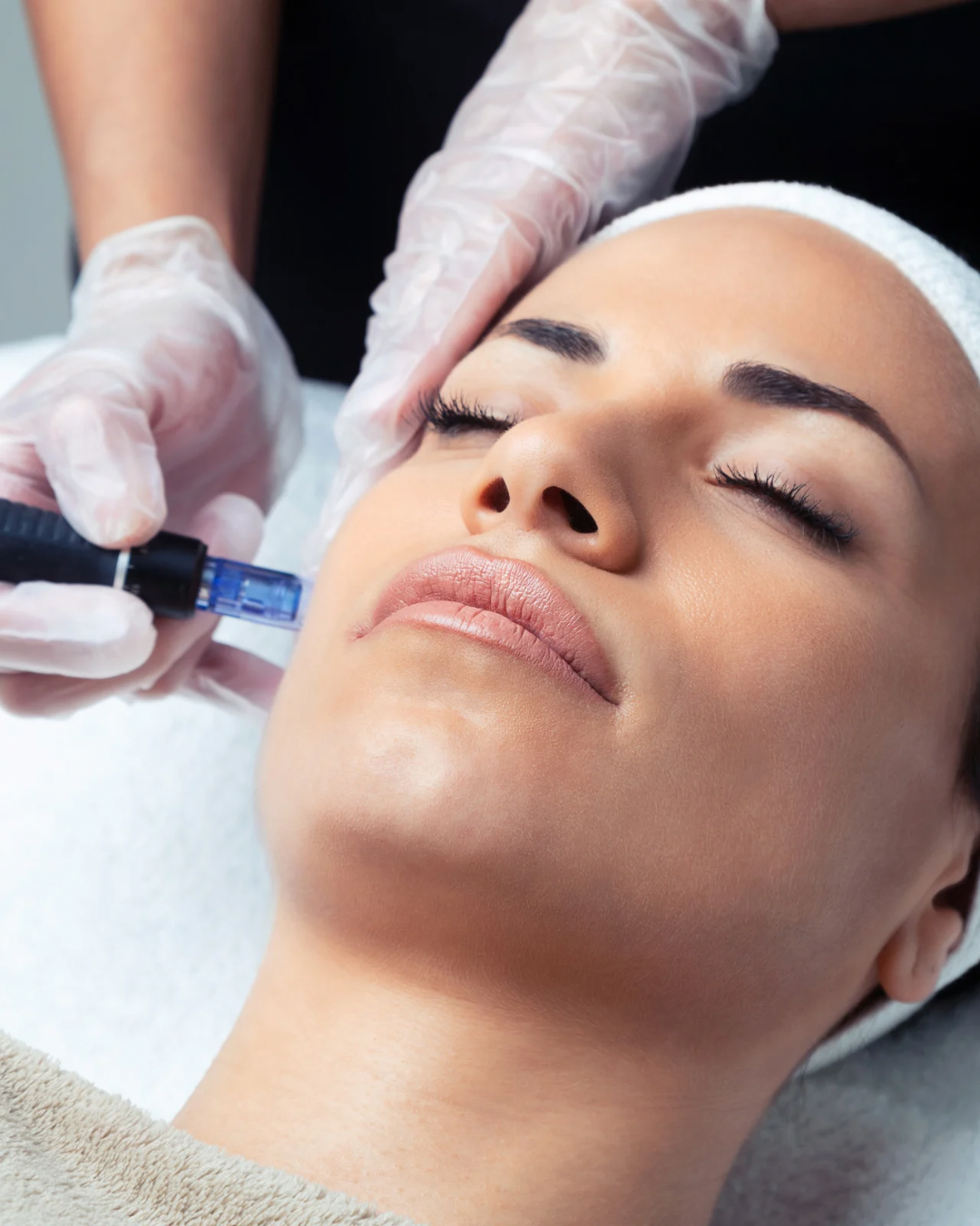 Microneedling
