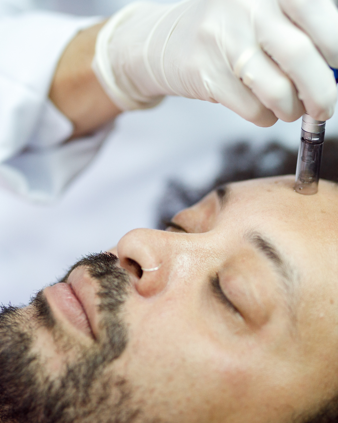 Microneedling für Herren
