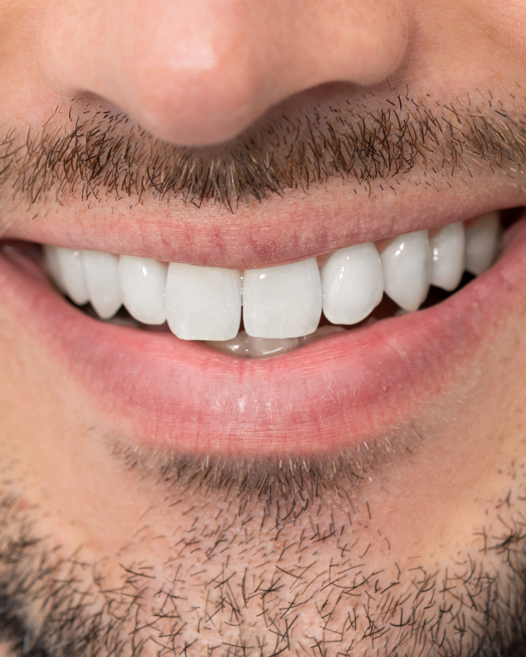 Kosmetisches Zahnbleaching für Herren